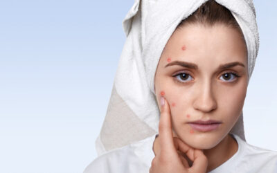 What Causes Acne and How to Treat It Online